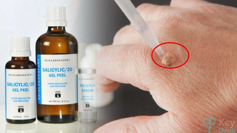 Thuốc chấm mụn cóc có chứa acid salicylic phổ biến