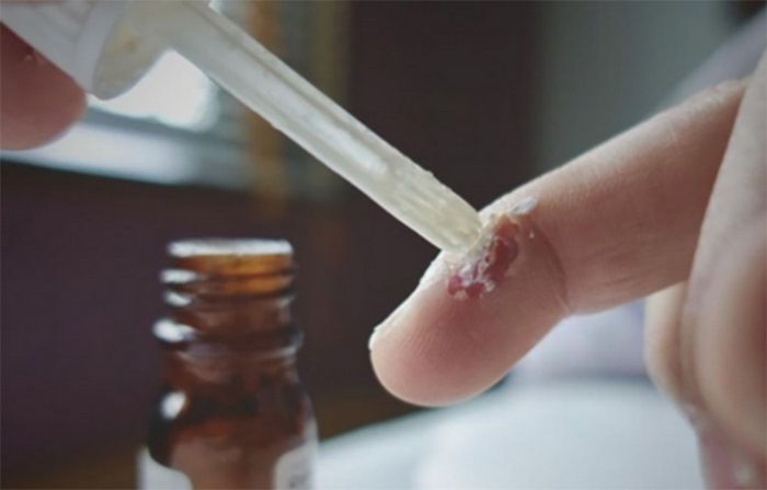 Lưu ý về tần suất dùng thuốc chấm cóc điều trị hiệu quả
