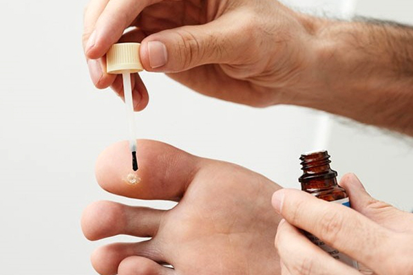 Đối tượng nên tránh sử dụng thuốc chấm mụn cóc