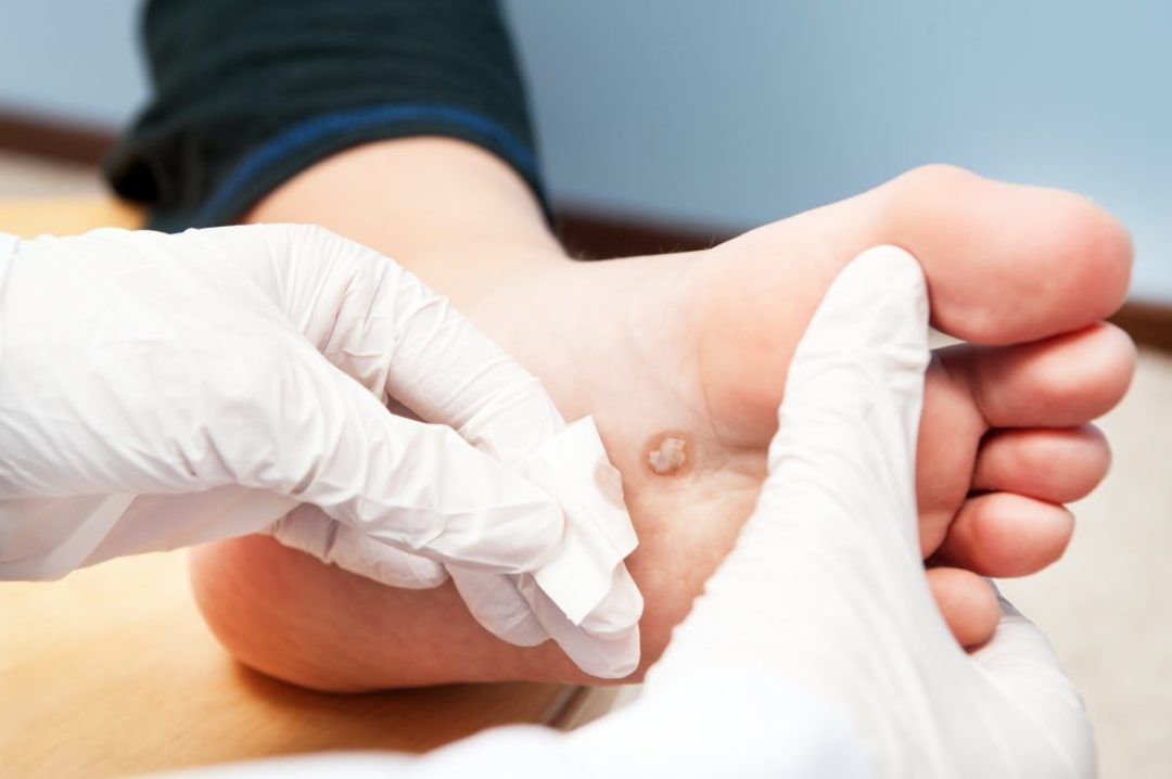 Khi nào nên gặp bác sĩ da liễu về mụn cóc