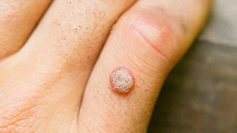 Thuốc chấm mụn cóc: Giải pháp hiệu quả và an toàn cho làn da của bạn