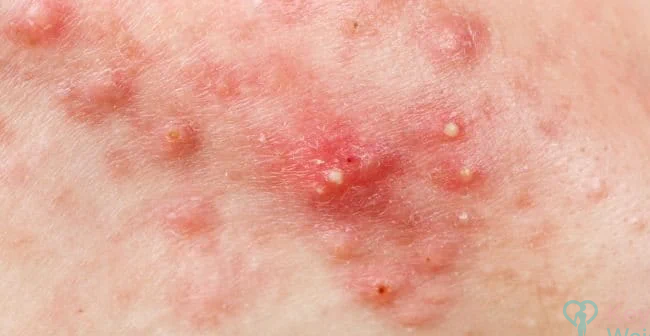 Định nghĩa về mụn viêm là gì?
