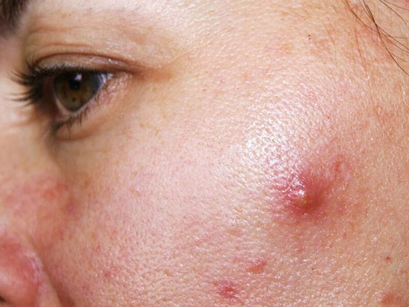Nguyên nhân gây mụn viêm xác định đúng để điều trị nhanh