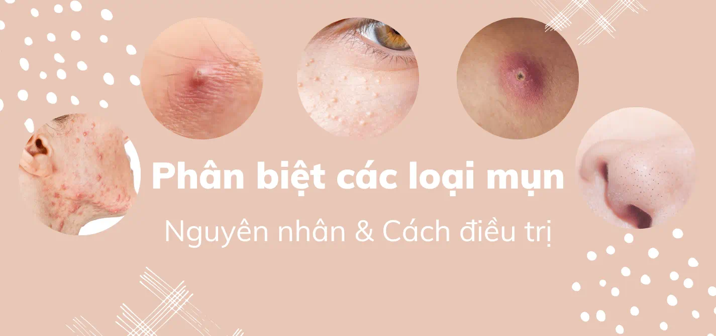 Dấu hiệu nhận biết mụn viêm và tình trạng để điều trị