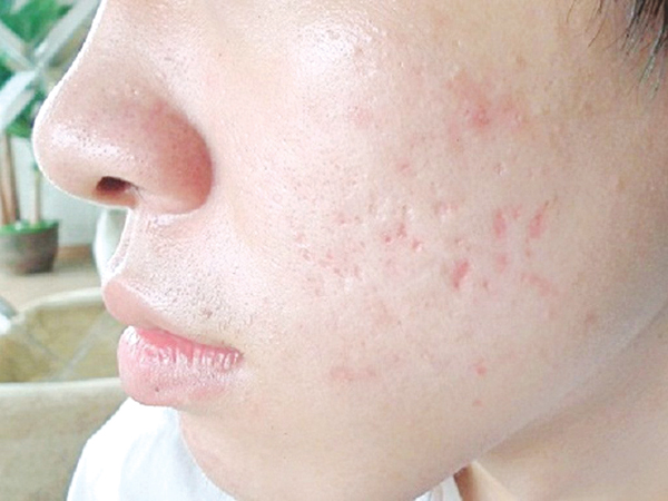 Tình trạng sẹo rỗ cần đến sự can thiệp y khoa chuyên sâu