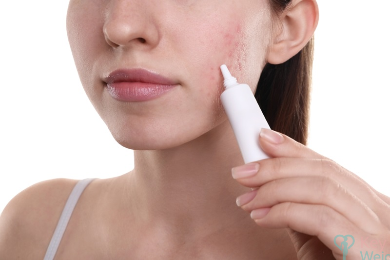 Cách chọn kem trị sẹo rỗ cho da khô và da nhạy cảm