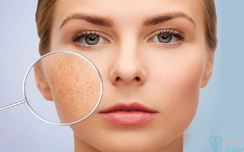 Cách chọn kem trị sẹo rỗ cho da thường, da hỗ hợp