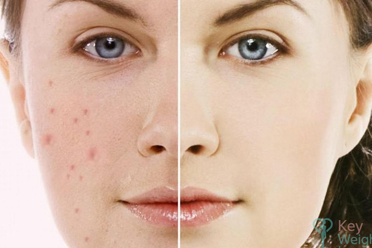 Các nguyên nhân cụ thể gây tăng sắc tố sau viêm do bệnh lý, vật lý…