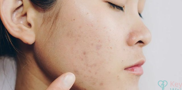 Yếu tố di truyền và loại da tăng sắc tố sau viêm