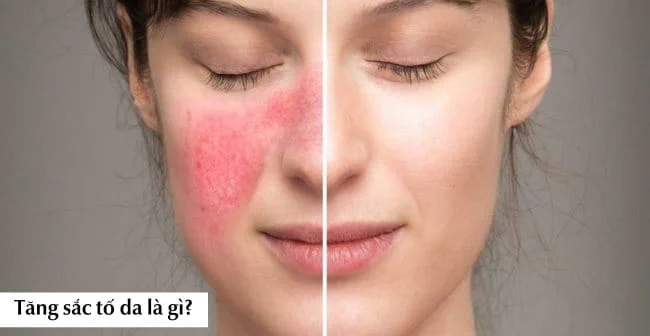 Tăng sắc tố da là gì và tại sao bạn cần quan tâm?