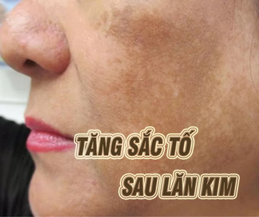 Nguyên nhân bên ngoài gây nên tình trạng tăng sắc tố da