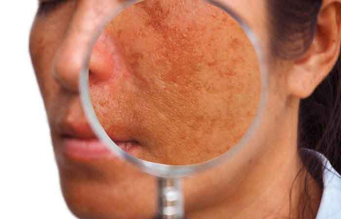 Nguyên nhân bên trong dẫn đến tăng sắc tố da