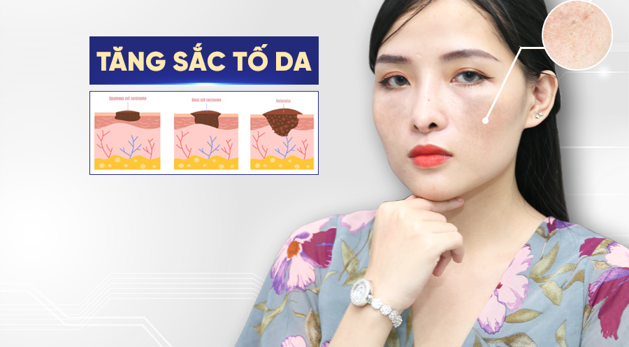 Phương pháp điều trị tăng sắc tố hiệu quả để cải tiện tình trạng da