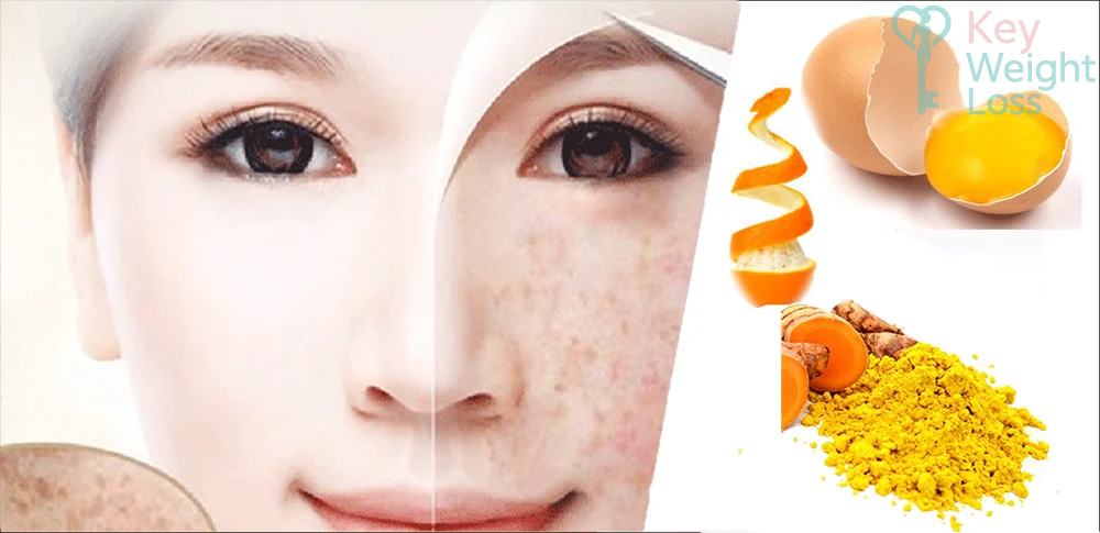 Cách trị tàn nhang đơn giản tại nhà với nguyên liệu tự nhiên